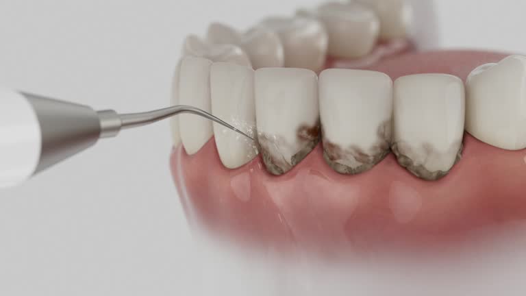 Reliable Dental Implants contractor in Glenwood, MN by Smile Center Dentistry